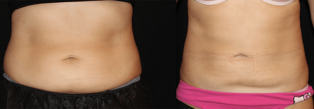CoolSculpting Before and After Photo by Perfect Med Spa in New York City, NY