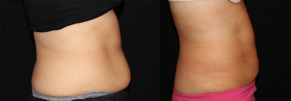 CoolSculpting Before and After Photo by Perfect Med Spa in New York City, NY