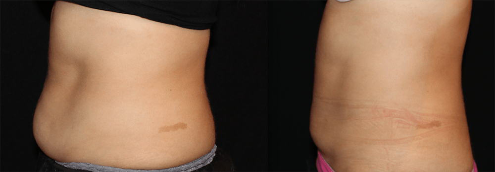 CoolSculpting Before and After Photo by Perfect Med Spa in New York City, NY