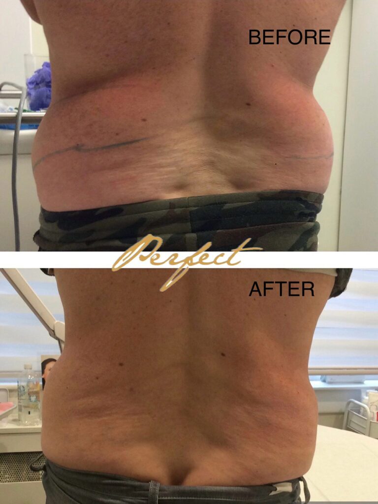 CoolSculpting Before and After Photo by Perfect Med Spa in New York City, NY