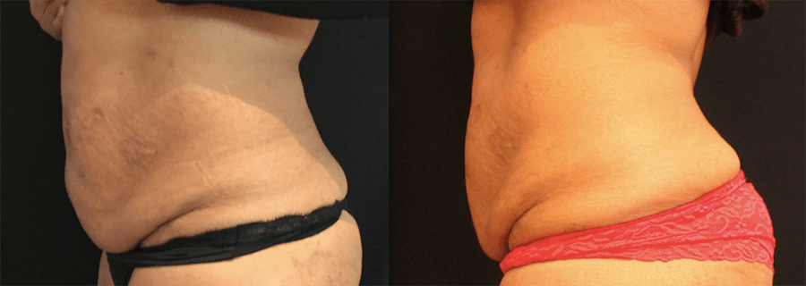 CoolSculpting Before and After Photo by Perfect Med Spa in New York City, NY