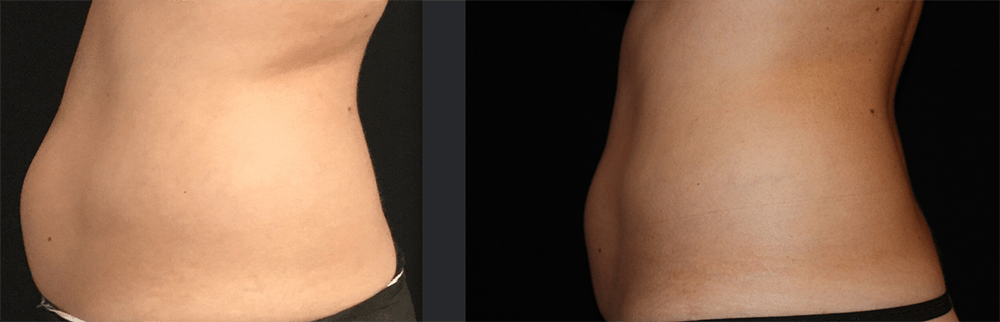 CoolSculpting Before and After Photo by Perfect Med Spa in New York City, NY