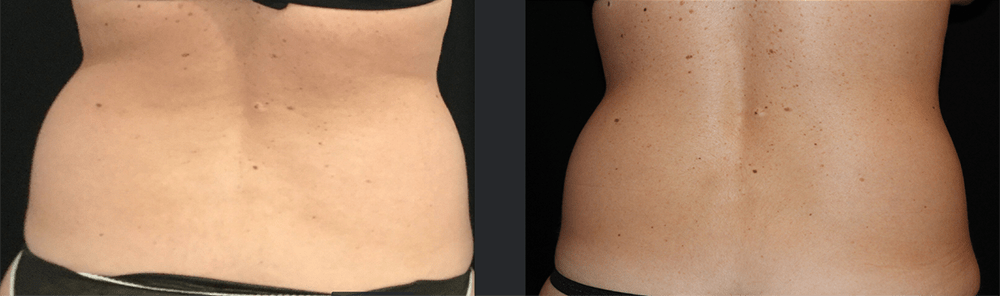 CoolSculpting Before and After Photo by Perfect Med Spa in New York City, NY