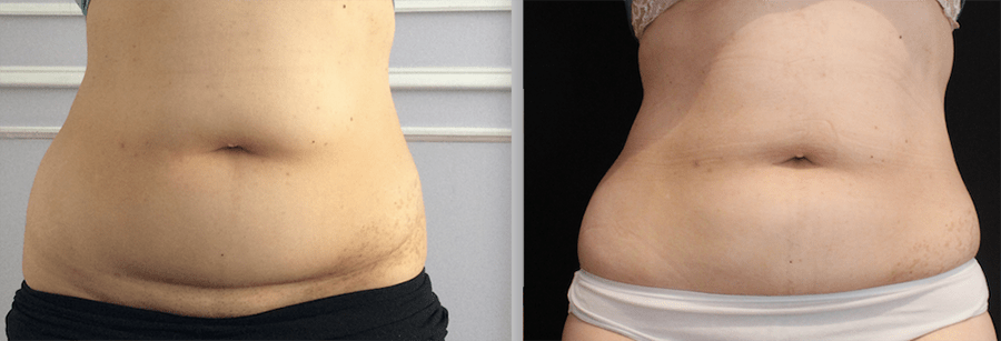 CoolSculpting Before and After Photo by Perfect Med Spa in New York City, NY