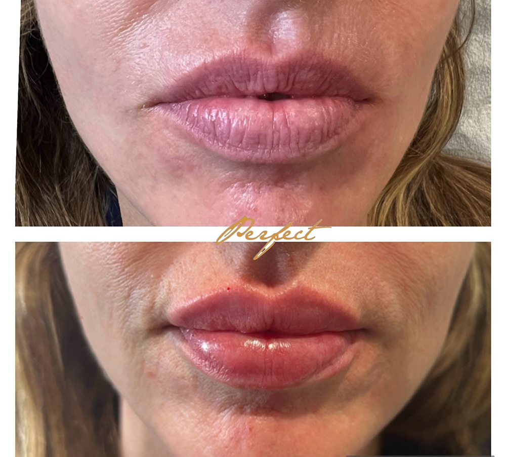 Lip Injections Facelift Before and After Photo by Perfect Med Spa in New York City, NY