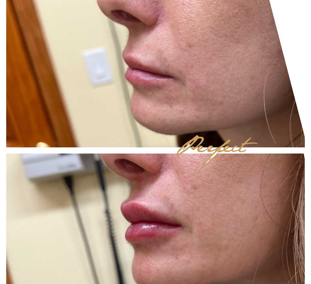 Lip Injections Facelift Before and After Photo by Perfect Med Spa in New York City, NY