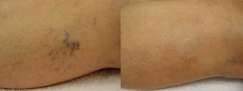 Spider Veins, Broken Capillaries Before and After Photo by Perfect Med Spa in New York City, NY