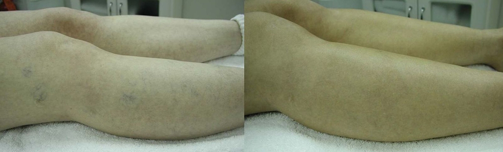 Spider Veins, Broken Capillaries Before and After Photo by Perfect Med Spa in New York City, NY