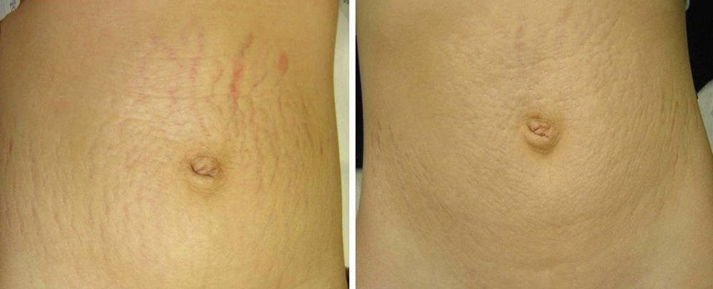 Stretch Marks Before and After Photo by Perfect Med Spa in New York City, NY