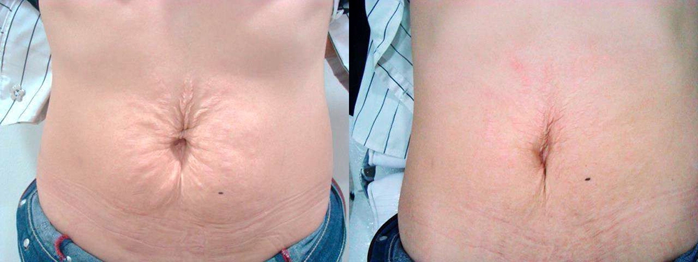 Stretch Marks Before and After Photo by Perfect Med Spa in New York City, NY
