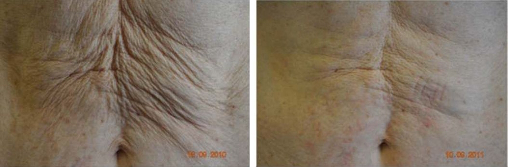 TightScupting Before and After Photo by Perfect Med Spa in New York City, NY