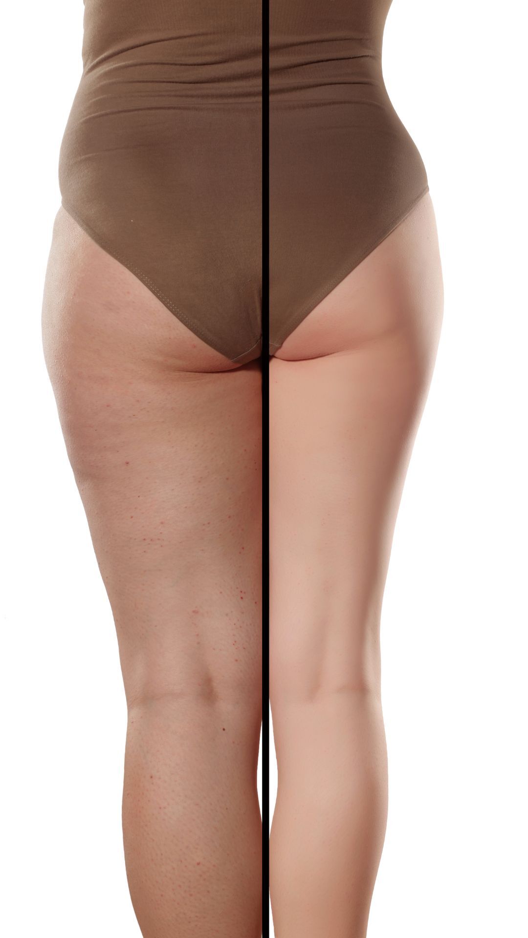 comparison of female legs with and without cellulite and fat comparison of female legs with and without cellulite and fat